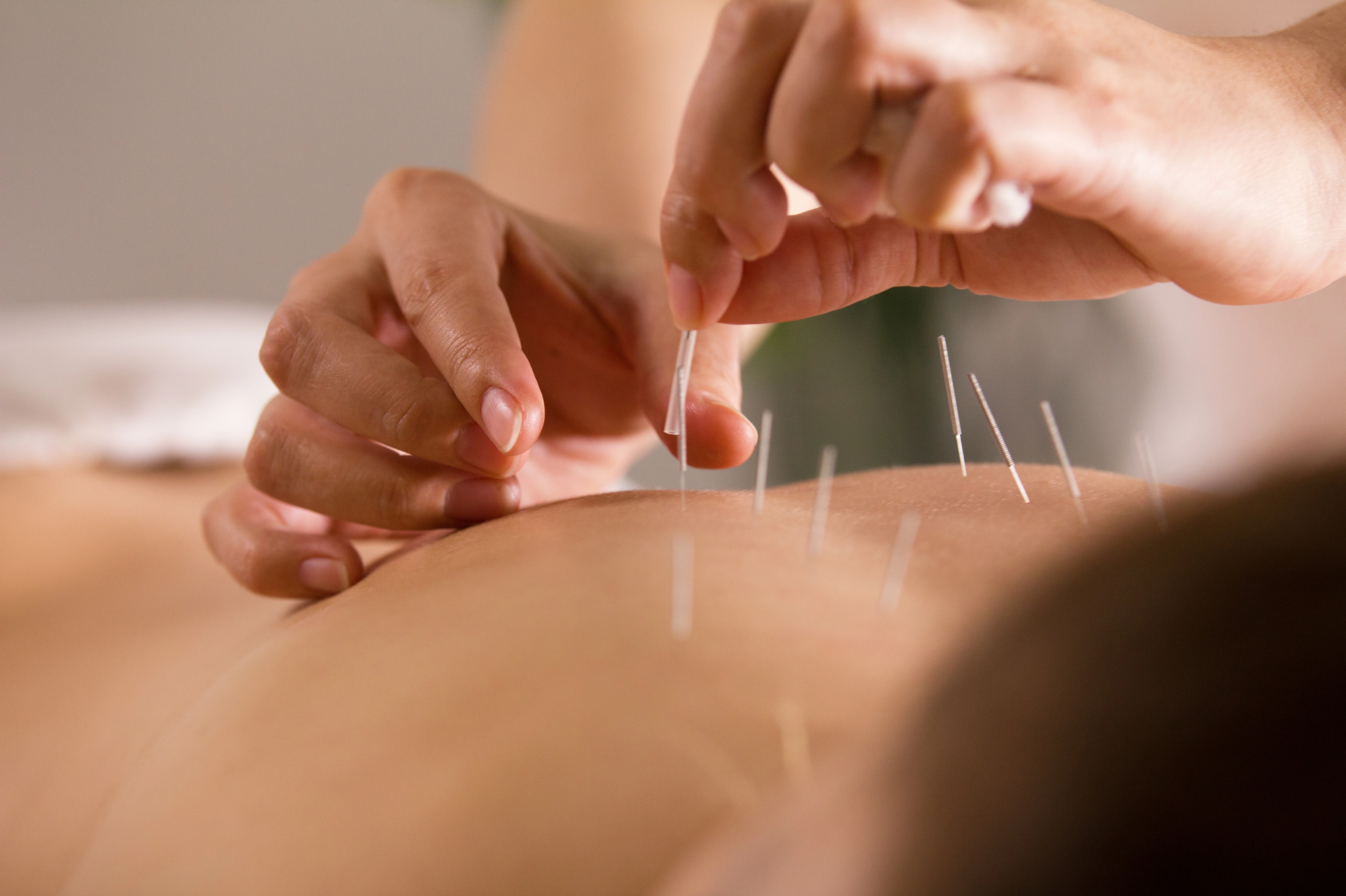 Finding Acupuncture Services in Brooklyn
