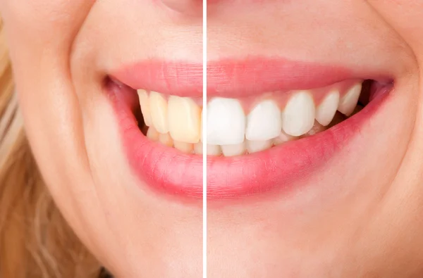 Whitening Strips vs In Office Treatment: The best teeth whitening method: Insights from Great Expressions Dental Centers Whitening Strips vs In Office Treatment: The best teeth whitening method: Insights from Great Expressions Dental Centers